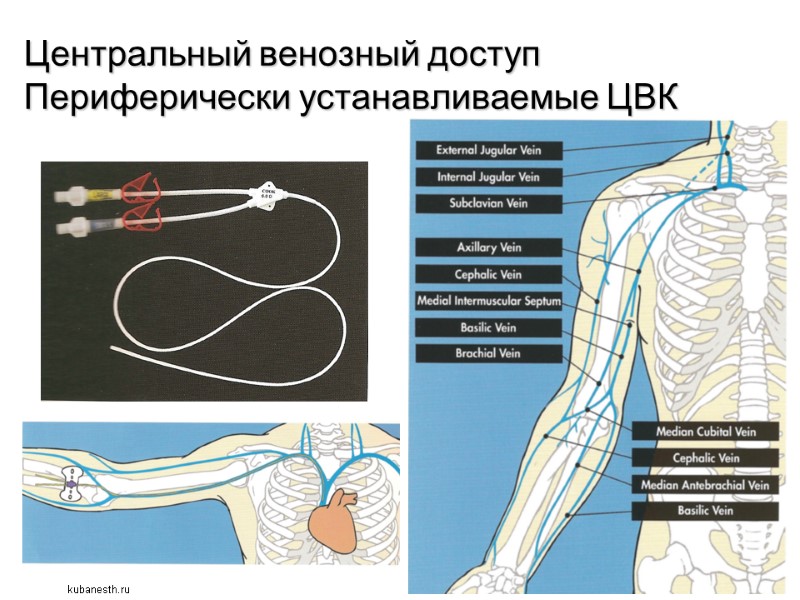 Центральный венозный доступ Периферически устанавливаемые ЦВК